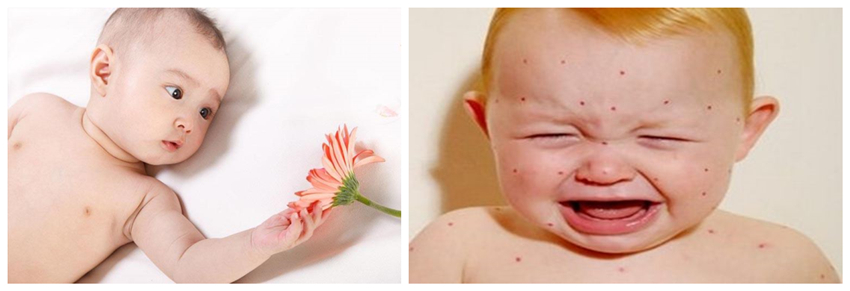 兒童濕疹反反復復,您有在家安裝家用除濕產品嗎?